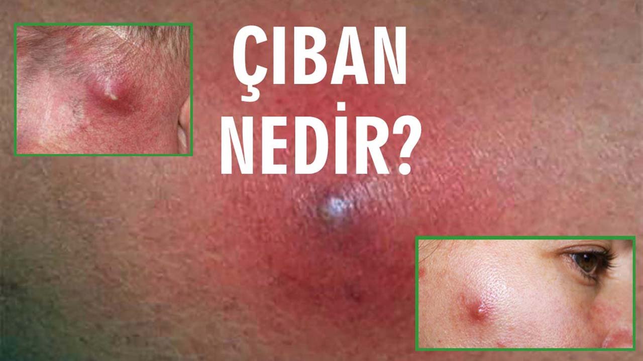 Rüyada Çıban görmek ne anlama gelir?