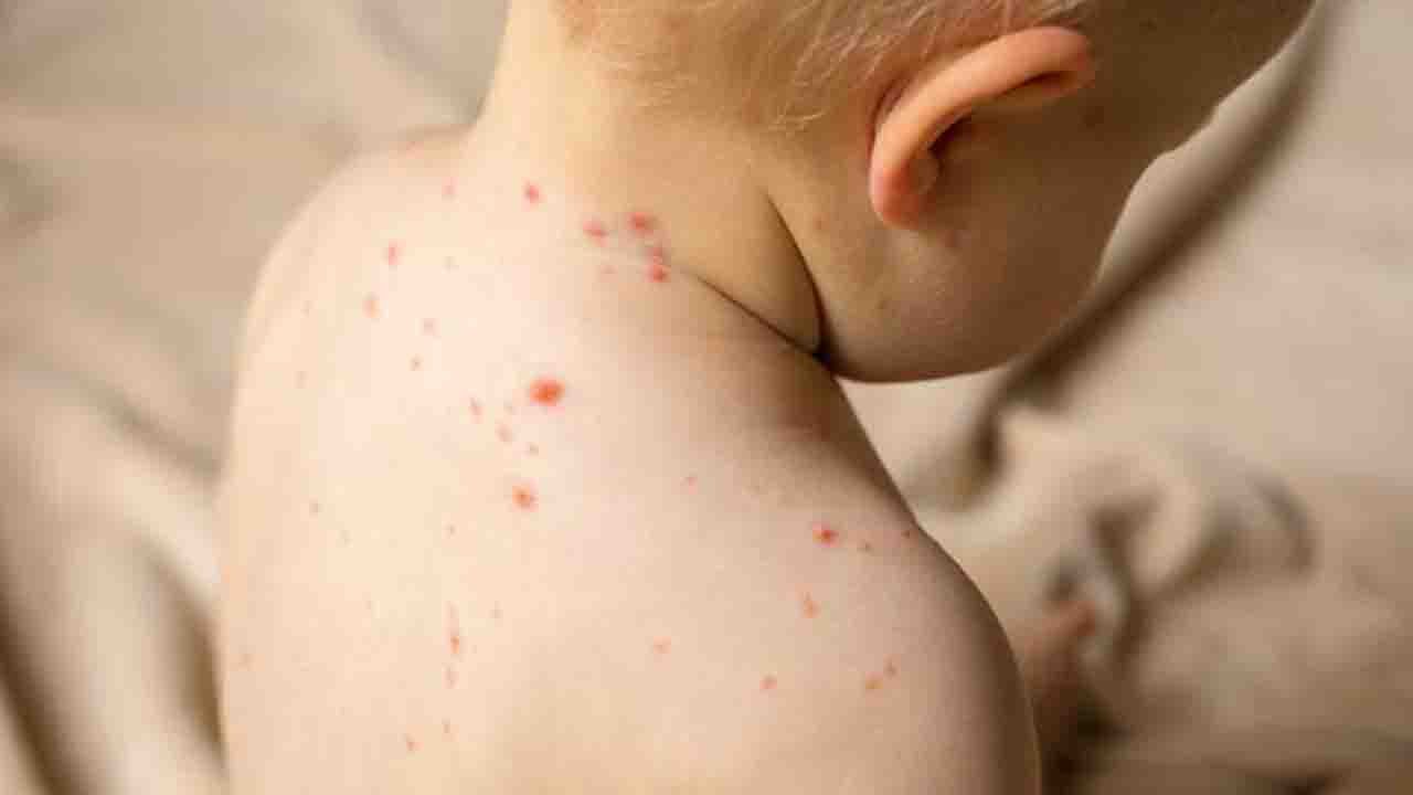 Rüyada Çiçek-Kızamık-Ekzema görmek ne anlama gelir?