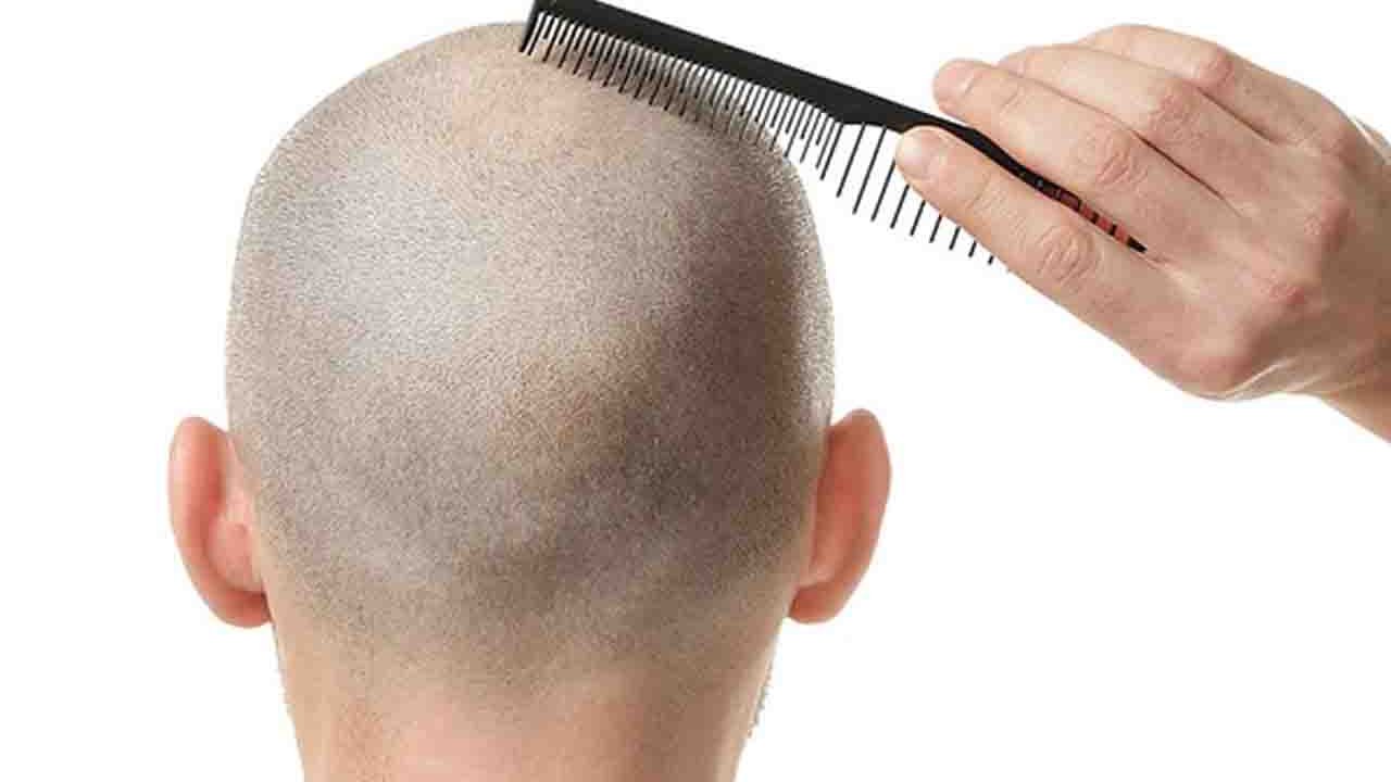 Rüyada Dazlak görmek ne anlama gelir?