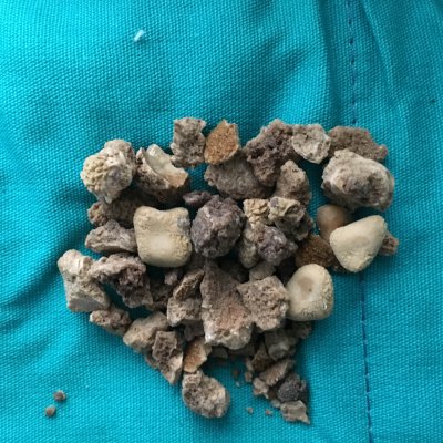 Hastanın böbreğinden çıkan taş şaşırtı