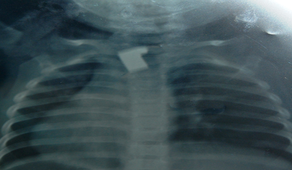 ÇOCUĞUN YEMEK BORUSUNDAN ANAHTAR PARÇASI ÇIKTI