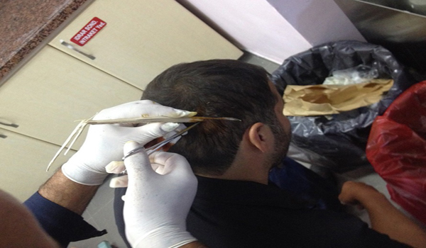 KAFASINA SAPLANAN ODUNLA HASTANEYE GELDİ