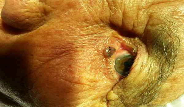 ELBİSTAN'DA GÖZ ALT KAPAĞI AMELİYATI