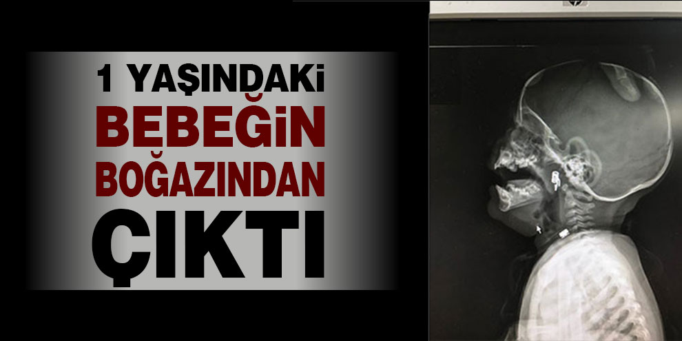 1 yaşındaki bebeğin boğazından çıktı
