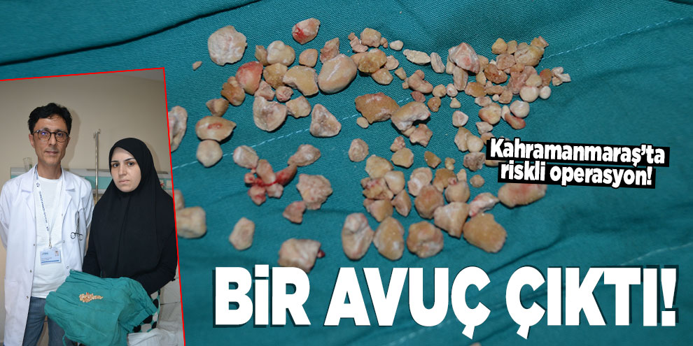 Kahramanmaraş’ta hastanın böbreğinden bir avuç taş çıkartıldı!