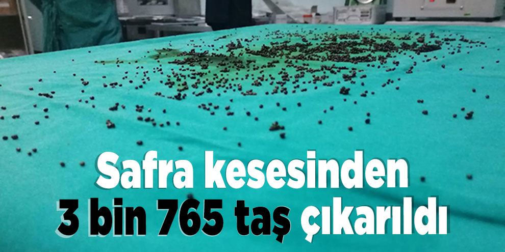 Safra kesesinden 3 bin 765 taş çıkarıldı