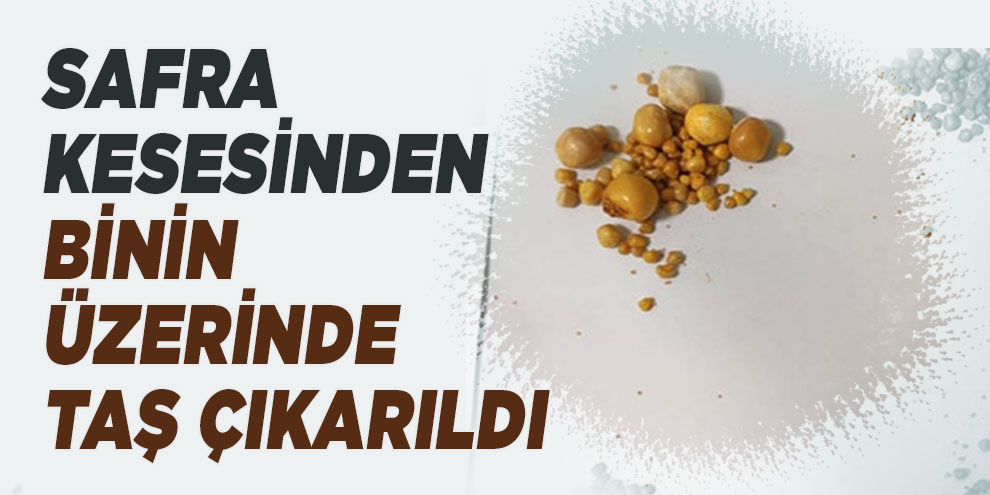 Safra kesesinden binin üzerinde taş çıkarıldı