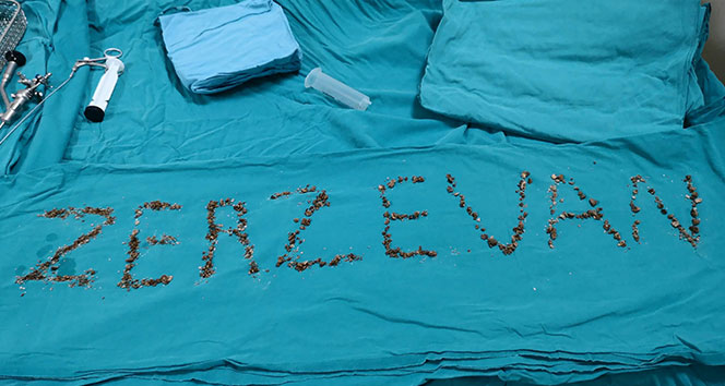 Böbreğinden yüzlerce taş çıktı