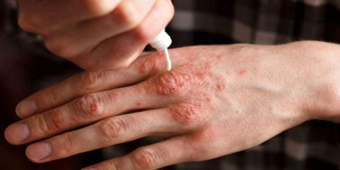 Sedef bulaşıcı bir hastalık değildir