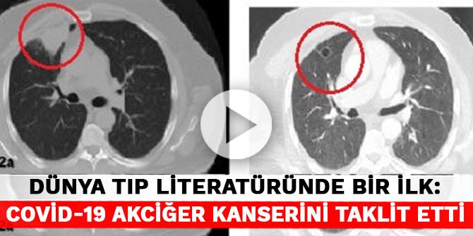 Dünya tıp literatüründe bir ilk: Koronavirüs, akciğer kanserini taklit etti